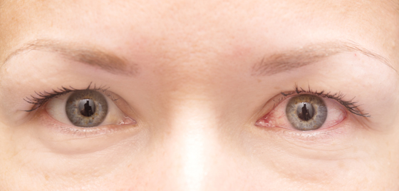 røde rennende blanke øyne allergi